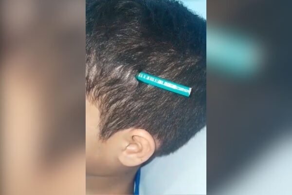 Menino de 9 anos é ferido após colega cravar lápis em sua cabeça na sala de aula