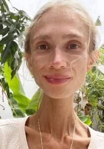 Mulher de 27 anos é encontrada morta em Bali após seguir dieta frutariana extrema e pesar apenas 22 kg