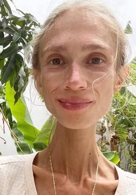 Mulher de 27 anos é encontrada morta em Bali após seguir dieta frutariana extrema e pesar apenas 22 kg