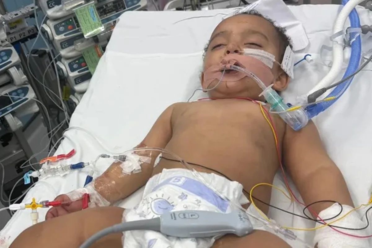 Bebê perde metade da língua e sofre queimaduras gravíssimas após ingerir soda cáustica achando que era leite